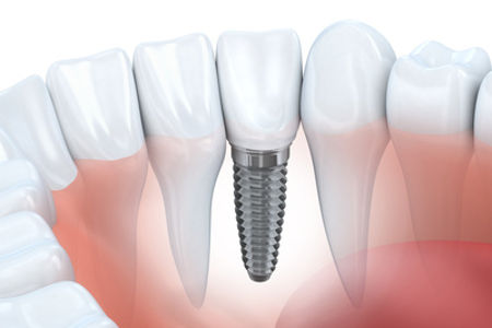 Mit einem Implantat als festsitzendem Zahnersatz bleibt das Gefühl echter Zähne erhalten